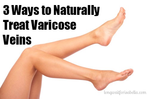 Natural Strategies for Treating Varicose Veins